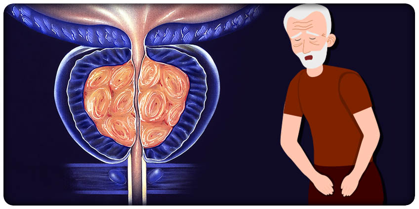 ZMAGASZ SIĘ Z DYSKOMFORTEM ZE STRONY PROSTATY?  Zobacz, jak zapewniają sobie ulgę mężczyźni tacy jak Ty